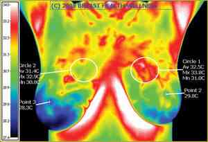 Breast Thermogram