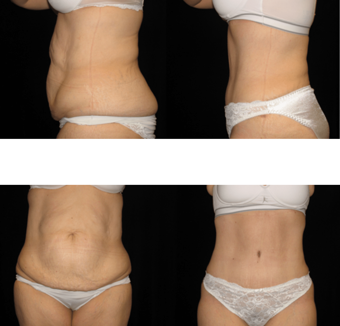 Azani Medical Spa Tummy Tuck Before and After Photo