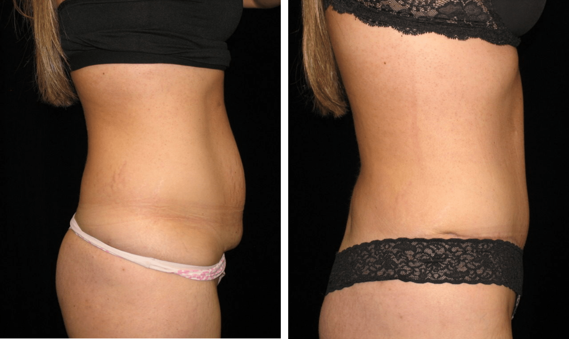 Azani Medical Spa Liposuction Before and After