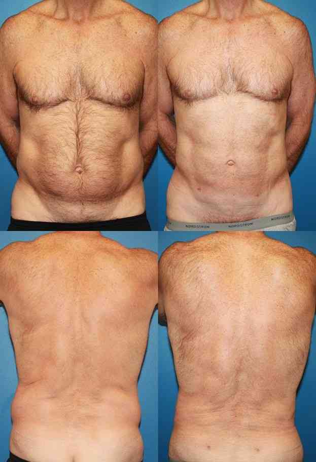 Before and After Liposuction Azani Medical Spa
