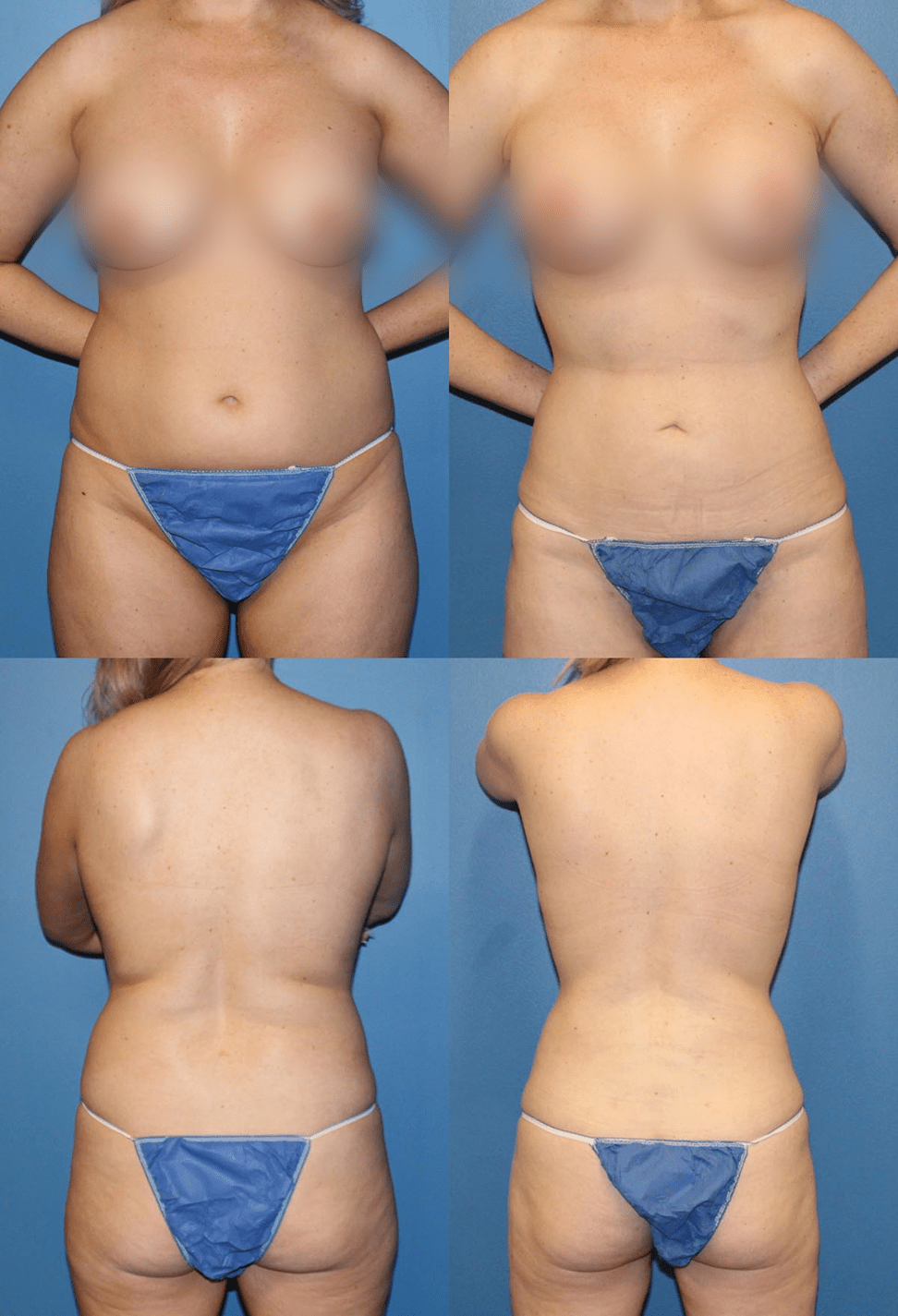 Before and After Liposuction Azani