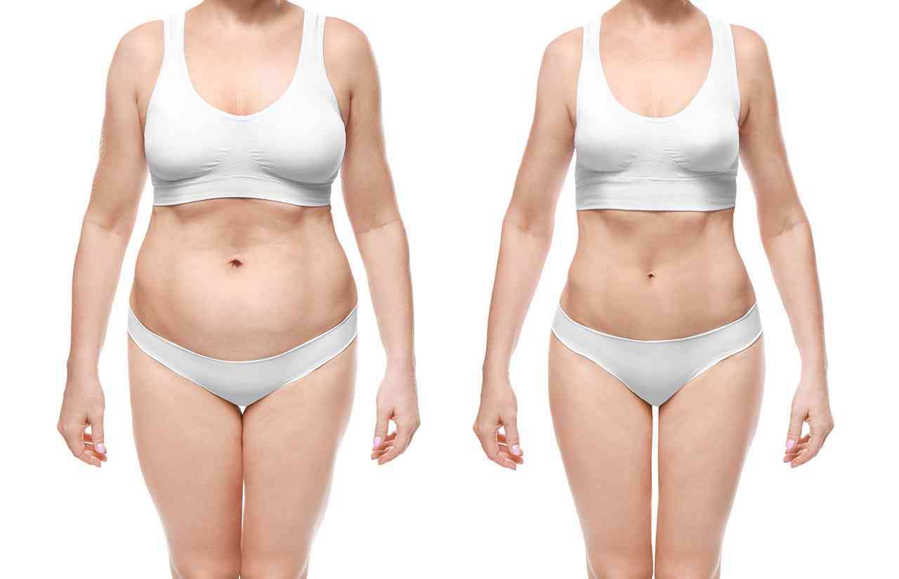 Liposuction Before and After Azani Medical Spa