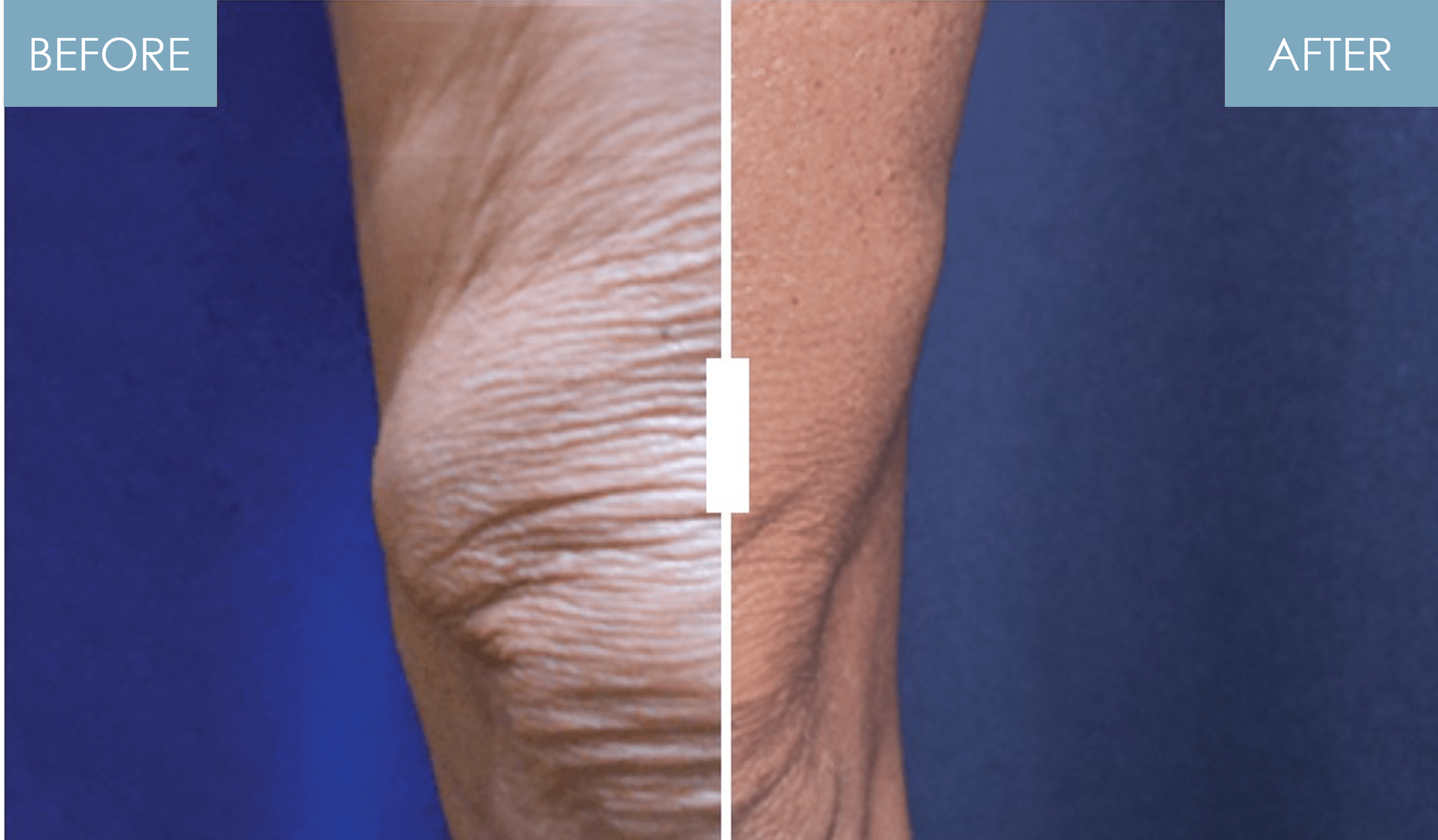 NuEra Skin Tightening by Azani Medical Spa Legs