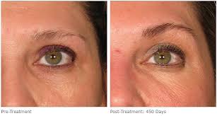 Permanent makeup eyebrow before and after 3