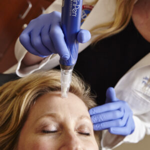 Microneedling One facial treatment TikTok special price